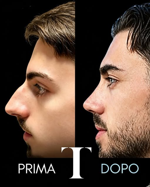 Prima e dopo di un caso di rinoplastica maschile pubblicato dal Dott. Tedeschi
